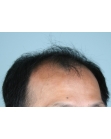 Before Hair Transplant&nbsp;2 Sessions (Areas)